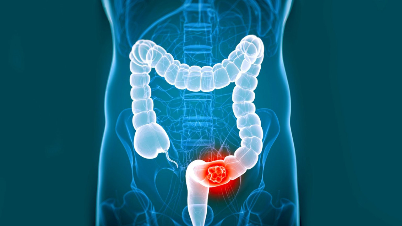 Colon Cancer Treatment in India
